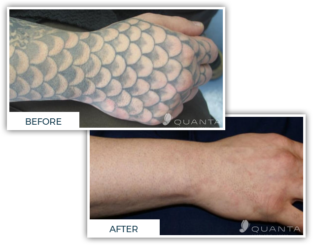 Chroma Tattoo Studio & Laser Tattoo Removal Clinic Metro Detroit - image-content-before-after