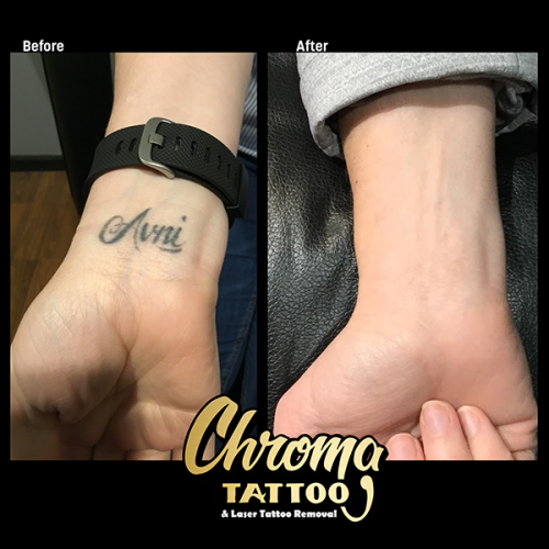 Laser Tattoo Removal in West Bloomfield - Affordable | Chroma Tattoo